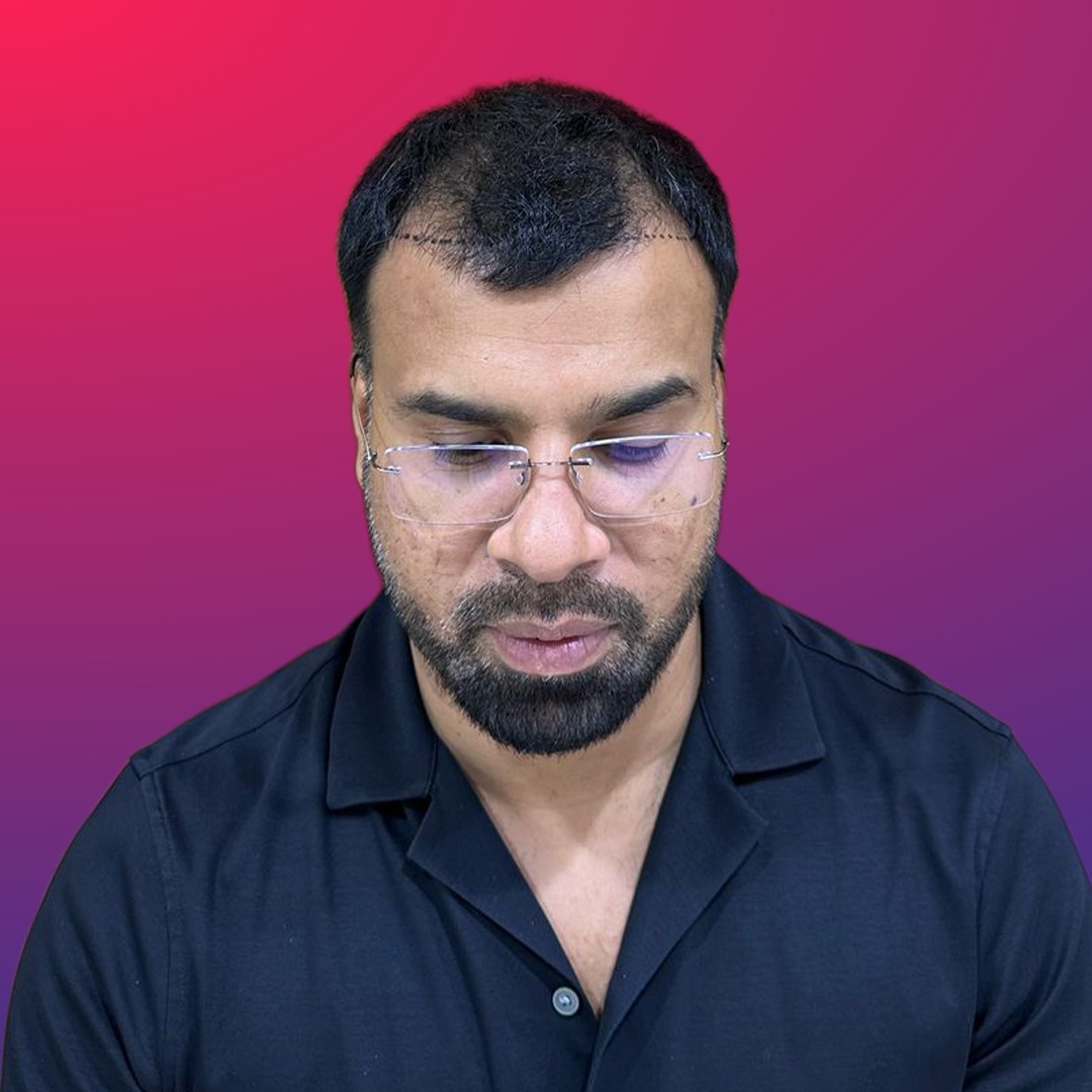 Hair transplant result