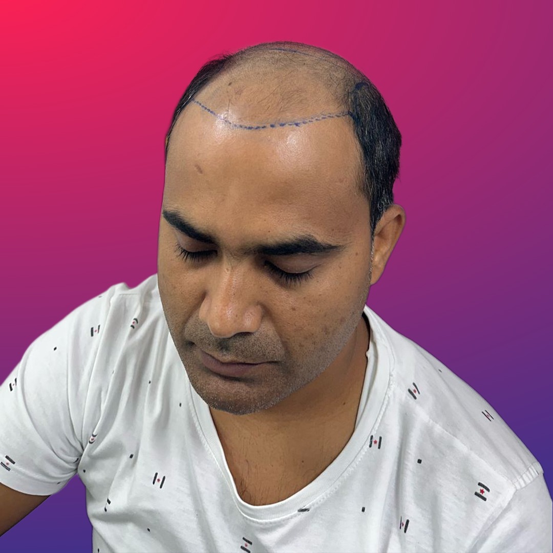 After hair transplant