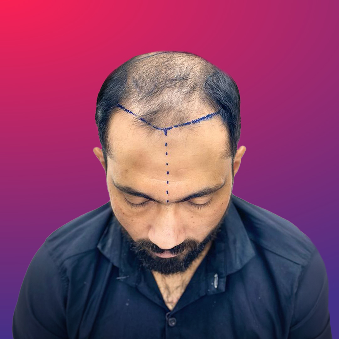 After hair transplant