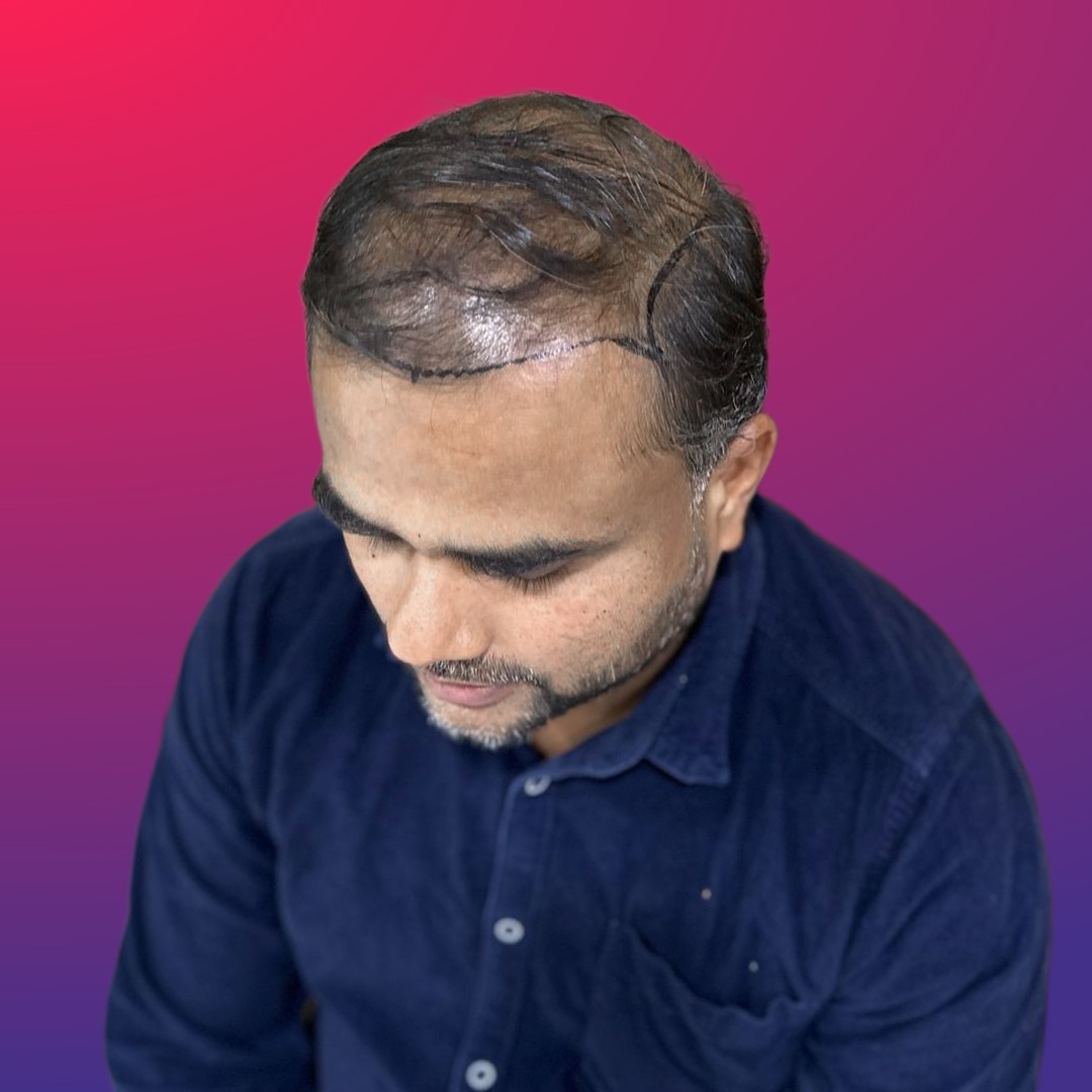 Before hair transplant