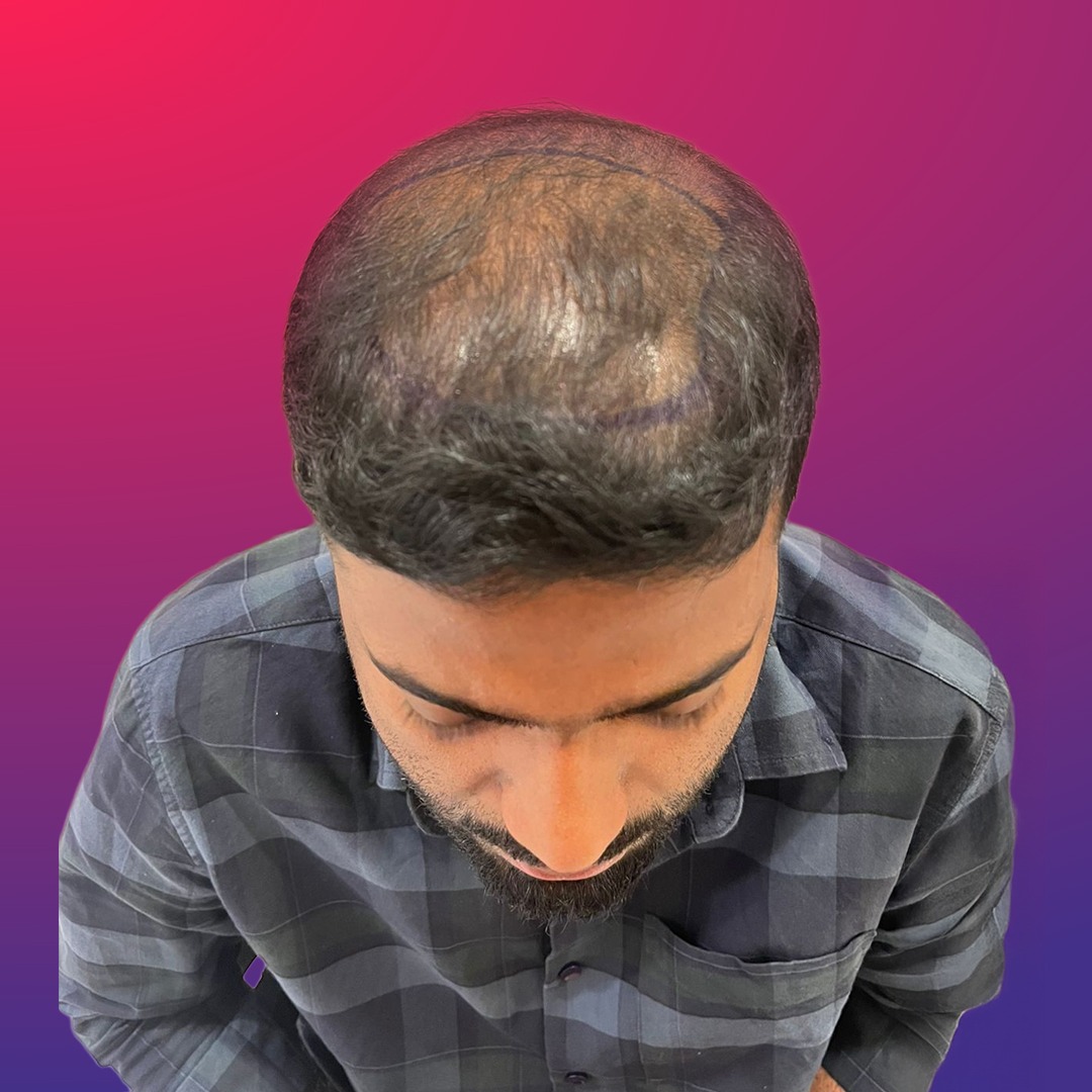 Before hair transplant